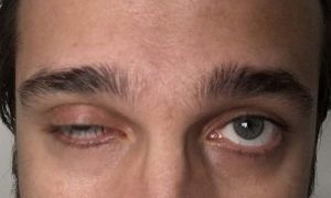 ptose-miastenia-1200x720